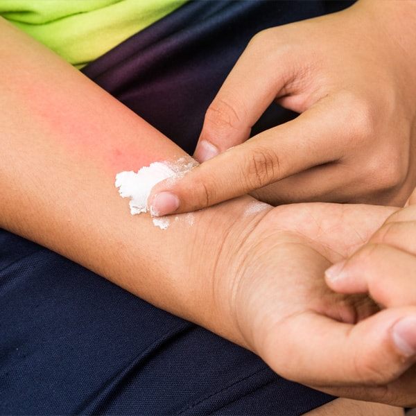 Le bicarbonate de soude et eau, un traitement local efficace