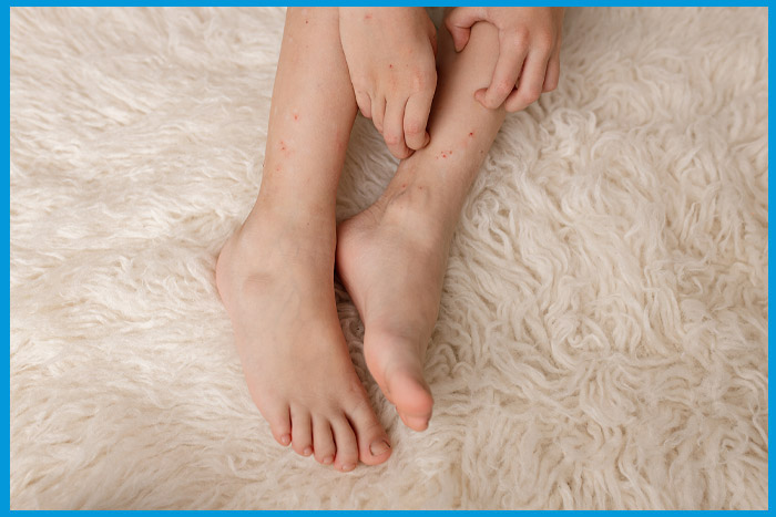 Piqûres de punaises de lit visibles sur les jambes d'un enfant