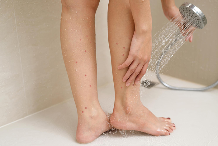 Lavage d'une jambe avec des piqûres de punaises de lit