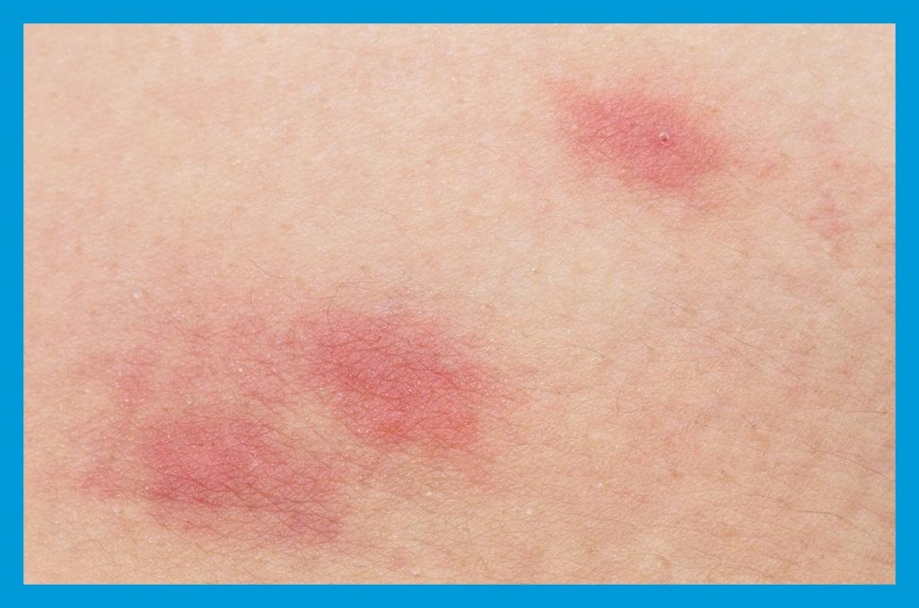 Comment soulager une piqûre de puce ?