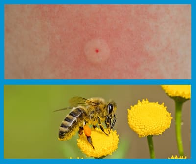 Les piqûres de guêpes et d'abeilles pour quelles conséquences