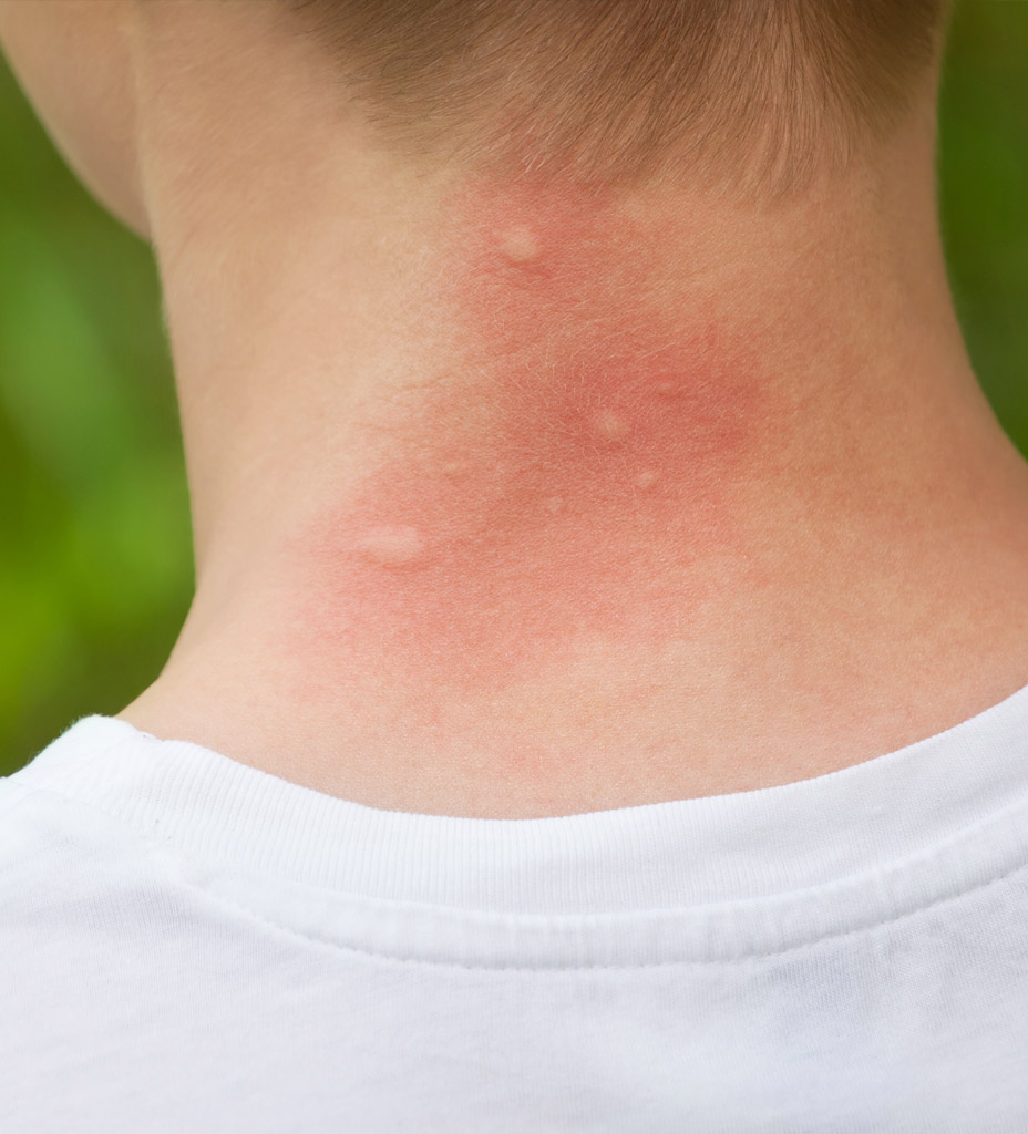 Piqûres de moustiques : comment les reconnaître et les soulager ?