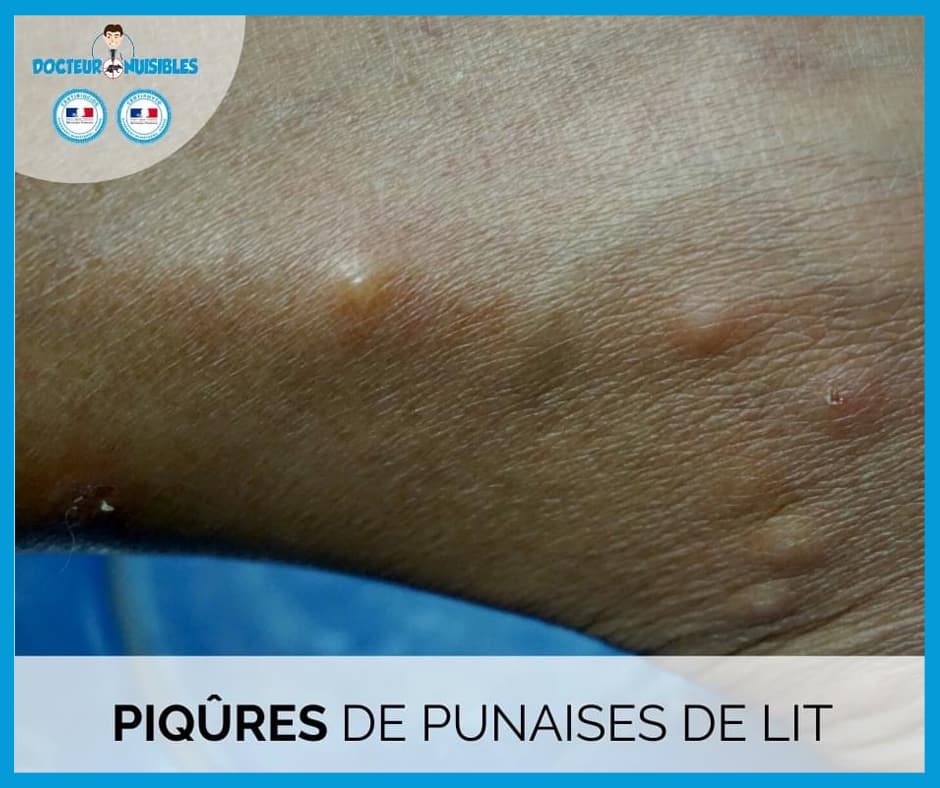 Punaises De Lit Et Traitement De La Peau Docteur Nuisibles