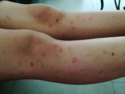 Photo de piqûres de punaises sur les jambes