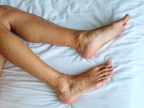 Photo de piqûres de punaises de lit sur les jambes et sur les pieds